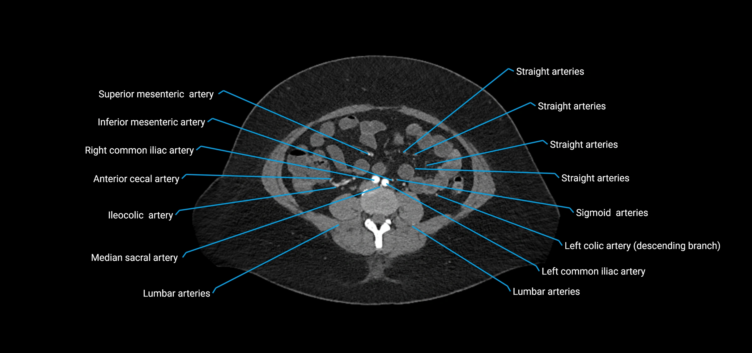 CTA abdomen axial cross sectional anatomy labelled image_129 (2).webp